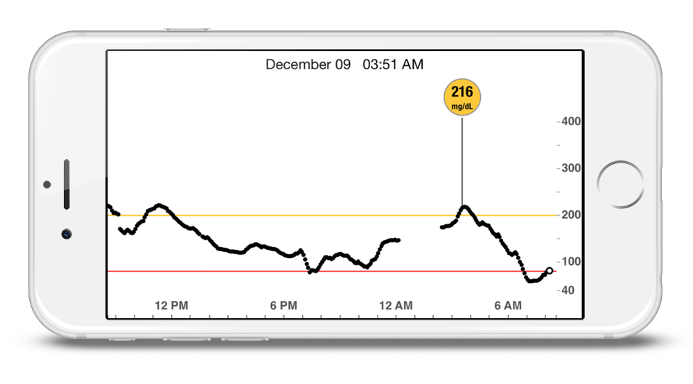 iPhone with a Dexcom 5 CGM graph